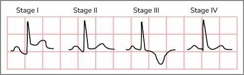 ECG Morphologic Features of Pericarditis
