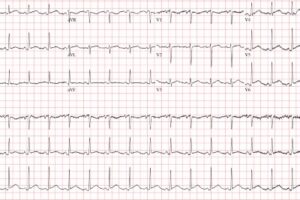 Acute pericarditis ECG