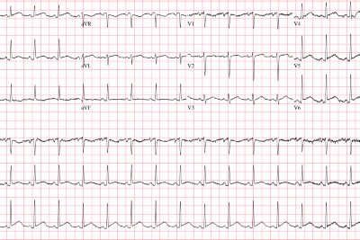 33-Year-Old With Pleuritic Chest Pain 33-Year-Old With Pleuritic Chest Pain