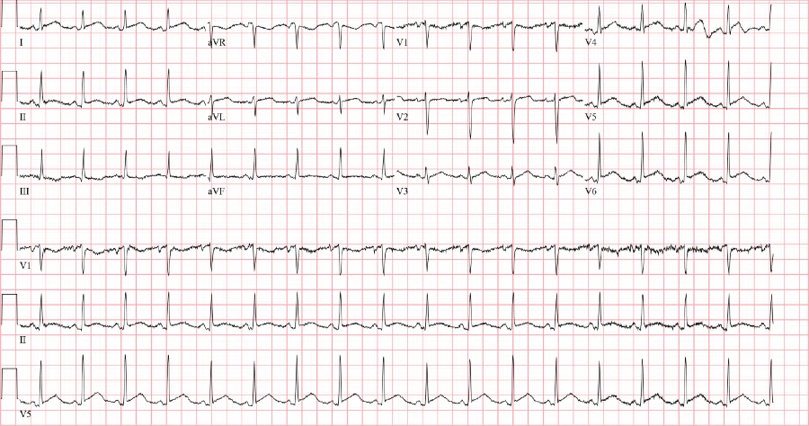 Acute pericarditis ECG