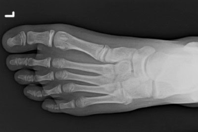 13-Year-Old With Inversion Injury 13-Year-Old With Inversion Injury