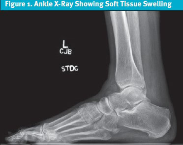 Ankle X-ray Showing Soft Tissue Swelling