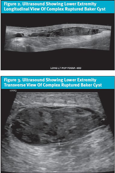 Ruptured Baker Cyst Complication, Ultrasound