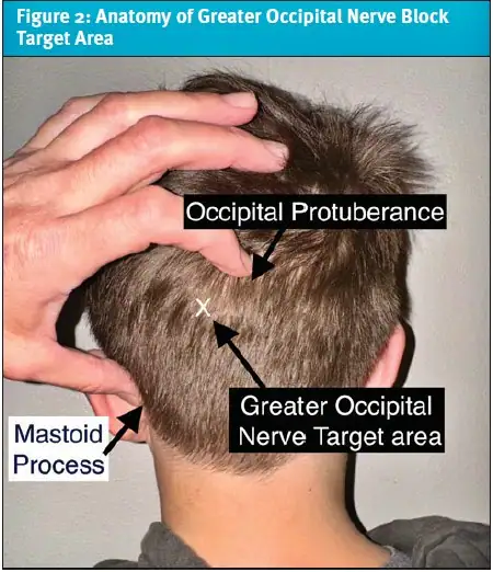 Nerve Block for Headache