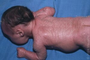Lamellar Ichthyosis