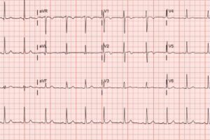 Wellens Syndrome