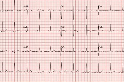 56-Year-Old With Episodes of Chest Pain 56-Year-Old With Episodes of Chest Pain