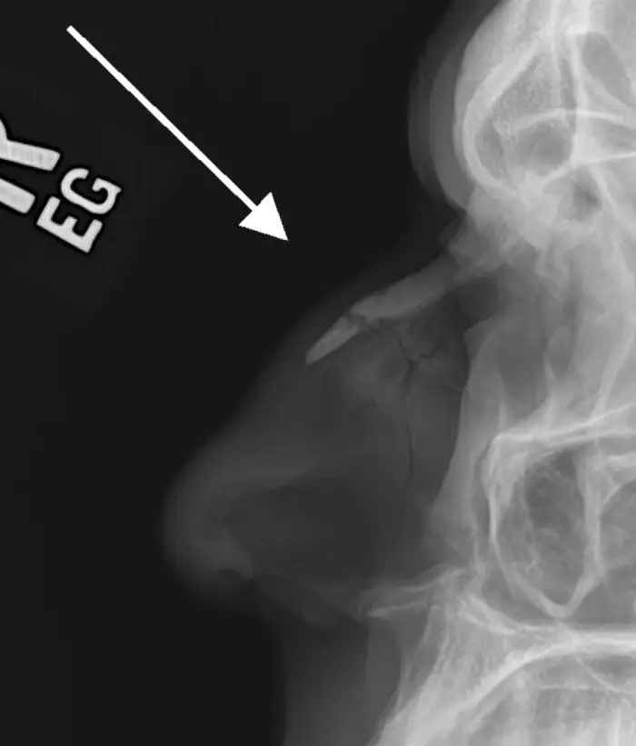 Fractures of the nasal bone and anterior nasal spine