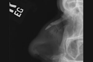 Fractures of the nasal bone and anterior nasal spine