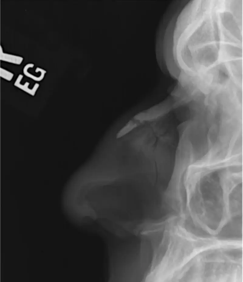 Fractures of the nasal bone and anterior nasal spine X-ray