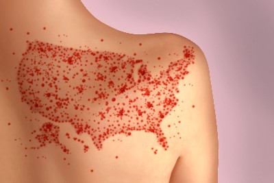 Measles Cases Keep Climbing, Exceeding Long-Term Records 