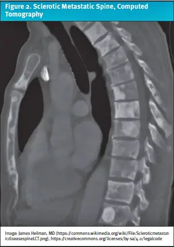 Back Pain From Prostate Cancer