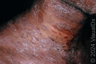 A 42-year-old Female with a Widespread Scaly Rash A 42-year-old Female with a Widespread Scaly Rash