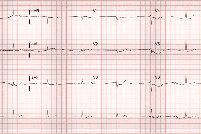 80-Year-Old With Substernal Chest Pain
