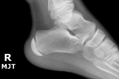 11-year-old With Heel Pain While Running 11-year-old With Heel Pain While Running