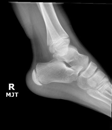 Heel Pain While Running