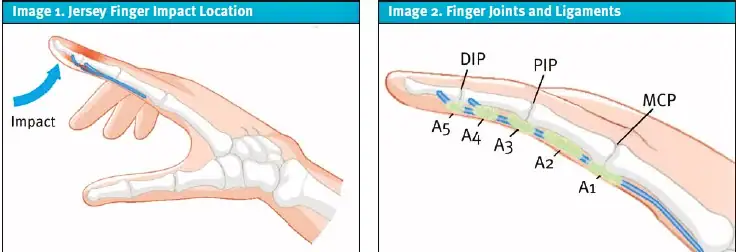 Jersey Finger in Urgent Care Illustrations
