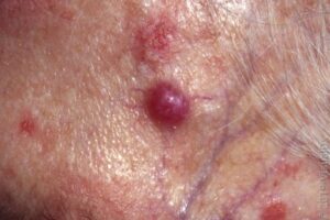 Merkel Cell Carcinoma