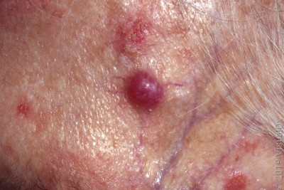 Merkel Cell Carcinoma