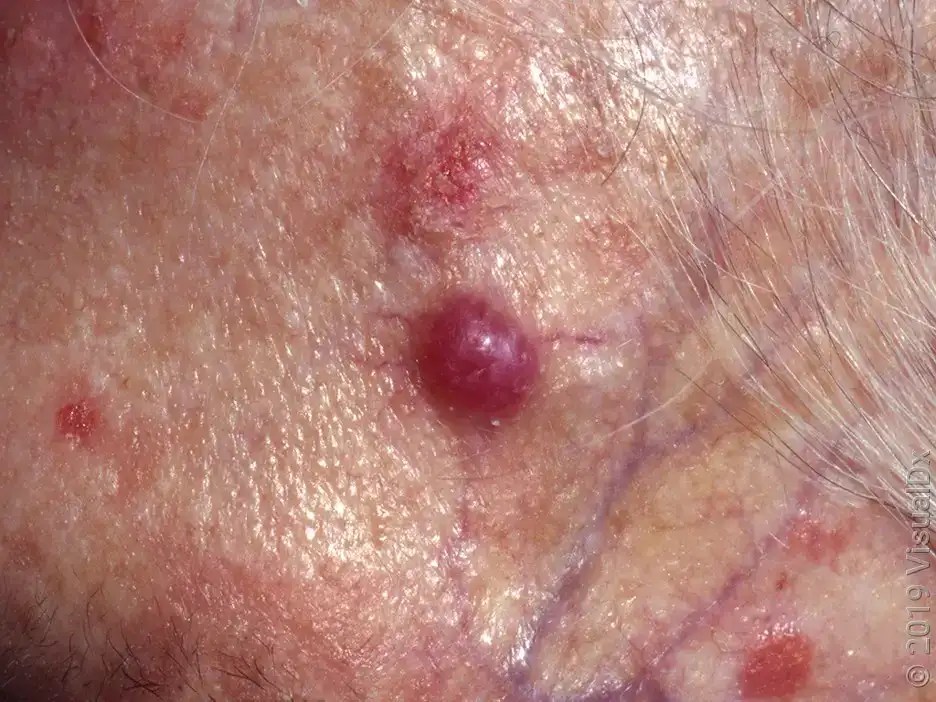 Merkel Cell Carcinoma 