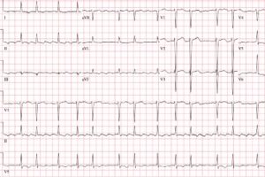 Atrial Flutter with Variable Conduction