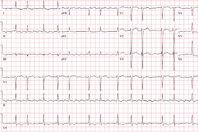 60-Year-Old With 2 Weeks of Dyspnea