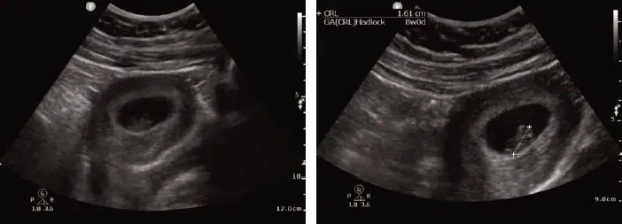 Pregnancy Diagnosis by POCUS in Urgent Care