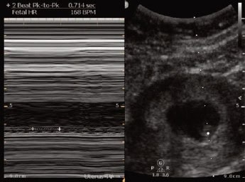 Pregnancy Diagnosis by POCUS in Urgent Care