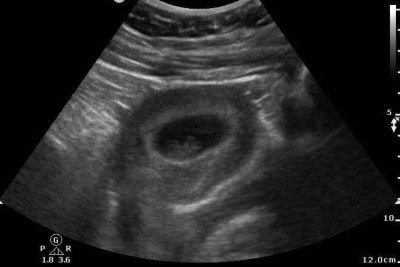 28-Year-Old Female with Left Lower Quadrant Pain