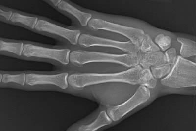 24-Year-Old Male Hand Pain After a Golf Game