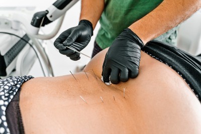 Acupuncture Helps Older Adults With Low Back Pain