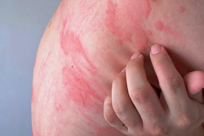 Oral Drug Targets Chronic Hives