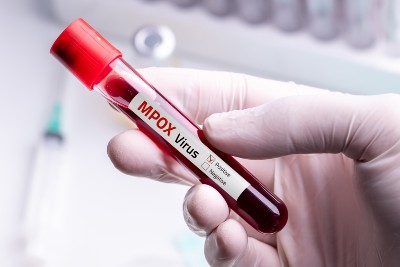 Severe Mpox Strain Spreads In California  Severe Mpox Strain Spreads In California