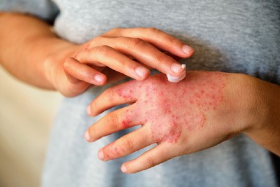 New Cream Option Treats Kids’ Atopic Dermatitis New Cream Option Treats Kids’ Atopic DermatitisÂ