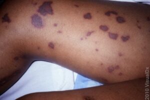 Acute Meningococcemia