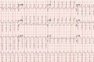 Supraventricular tachycardia (SVT) with aberrancy