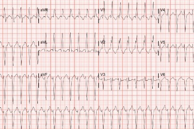 60-Year-Old With Palpitations