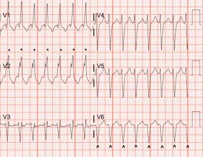 Figure 2: RSR’ in V2 indicated here (*) as well as the deep S-wave in V6 (^)