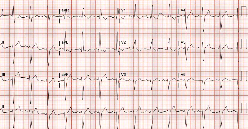 Figure 3: Patient’s repeat ECG