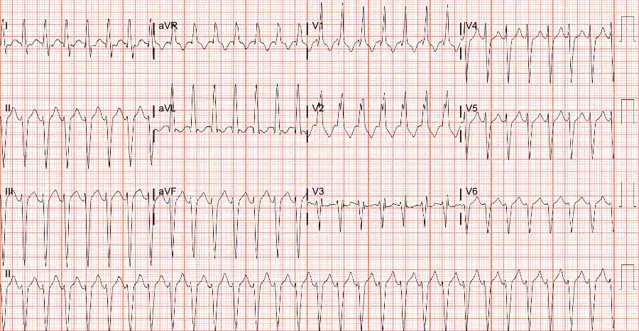 Supraventricular Tachycardia (SVT) with Aberrancy