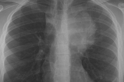 21-Year-Old Male With Cough and Night Sweats 21-Year-Old Male With Cough and Night Sweats