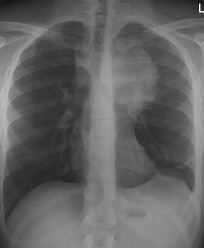 Anterior Mediastinum Mass