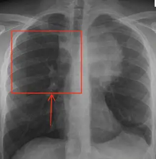 Anterior Mediastinum Mass Identified by Arrow and Square on X-ray