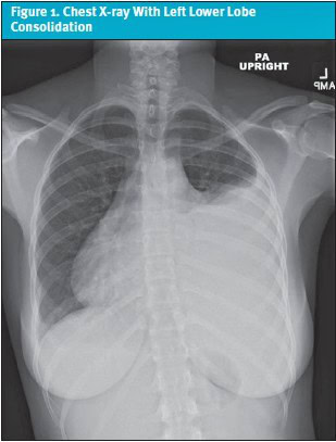 Cardiopulmonary Debut of Systemic Lupus Erythematosus