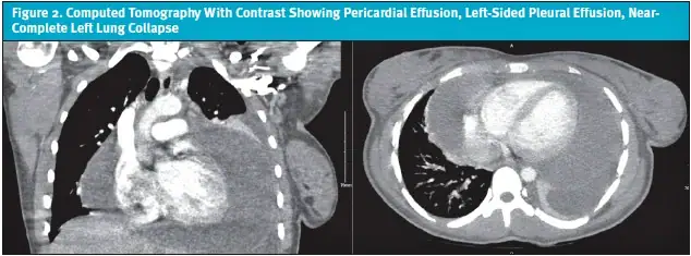 Cardiopulmonary Debut of Systemic Lupus Erythematosus