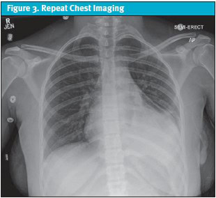 Cardiopulmonary Debut of Systemic Lupus Erythematosus; Repeat Chest X-ray