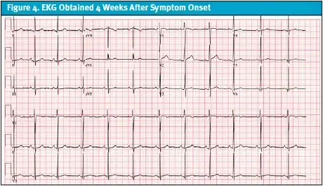 EKG 4 Weeks After Symptom Onset