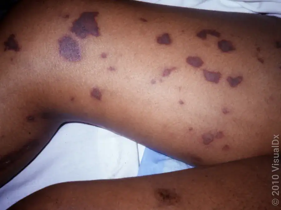 Acute Meningococcemia