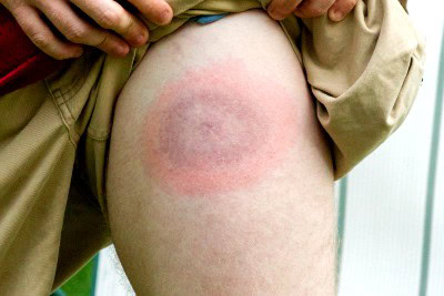 As Lyme Disease Risk Increases, Protective Measures Are Lacking