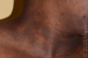 Lichen Planus Pigmentosus in Urgent Care
